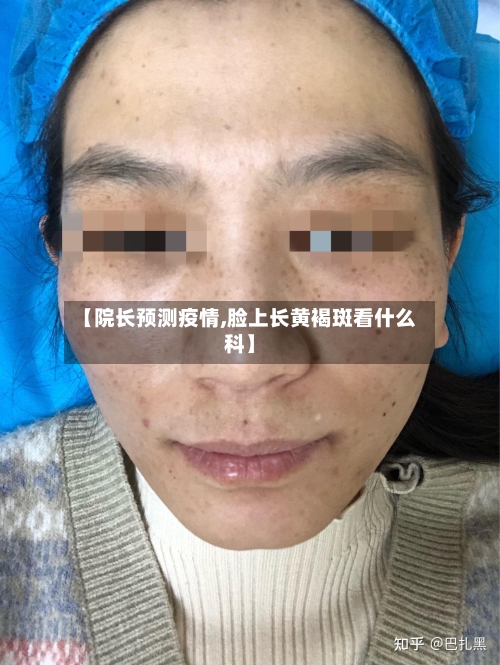 【院长预测疫情,脸上长黄褐斑看什么科】