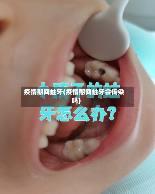 疫情期间蛀牙(疫情期间蛀牙会传染吗)-第2张图片