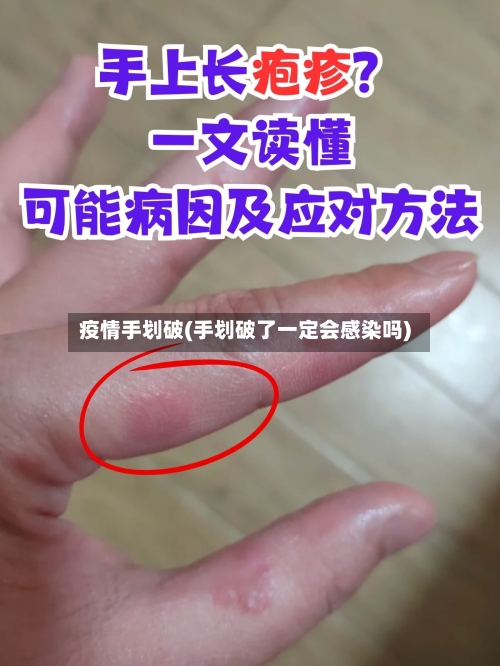 疫情手划破(手划破了一定会感染吗)