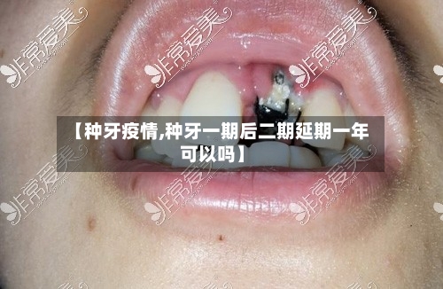 【种牙疫情,种牙一期后二期延期一年可以吗】